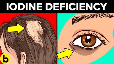 7 Signs You Have An Iodine Deficiency - YouTube