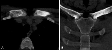 Hyperostosis, sternocostoclavicular; Sternocostoclavicular Hyperostosis