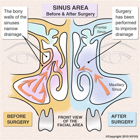 Sinus Surgery NYC