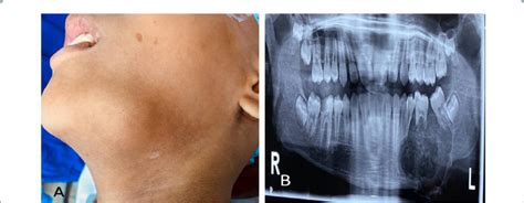 (A) Clinical picture showing swelling involving left horizontal ramus ...