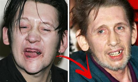 Shane MacGowan's teeth: Before and after transformation | Express.co.uk