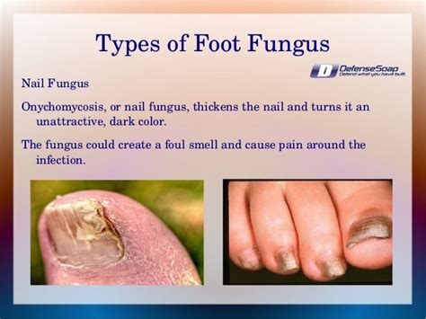 Foot Fungus in Athletes