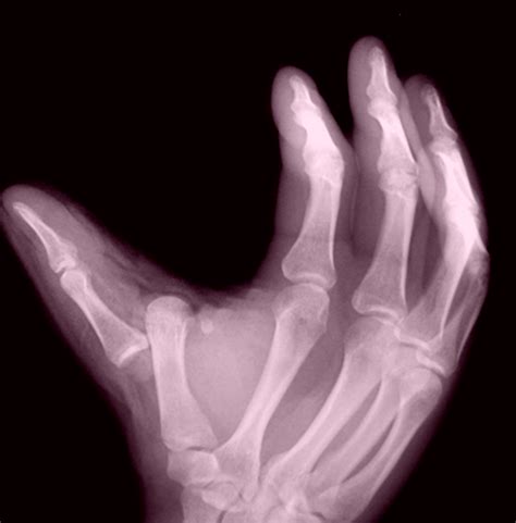 Broken Thumb - Treatment, Symptoms, Pictures