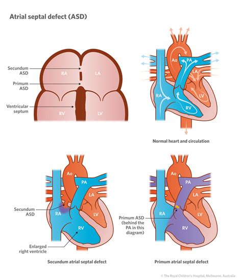 Cardiology : Atrial Septal Defect