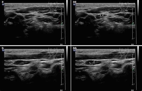 Normal Ultrasound of Thyroid Gland and Lymph Nodes | Radiology Key