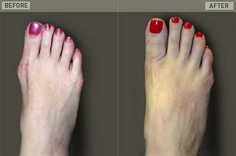 PODIATRIST DISCUSSES CINDERELLA FOOT SURGERY