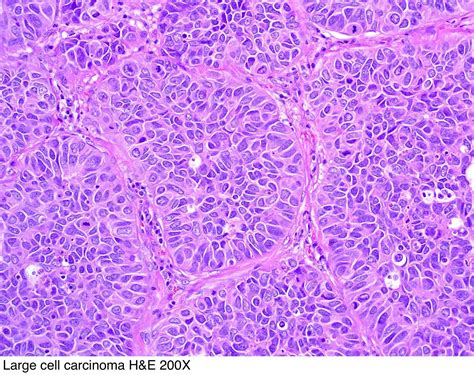 Pathology Outlines - Large cell