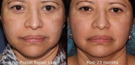 Melasma Skin Treatment by San Diego Dermatology Specialists