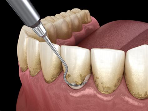 Periodontal Disease Treatment - van Hofwegen Dental in Sioux Falls, SD