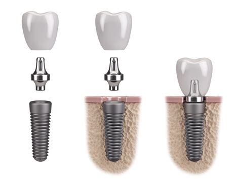 Top 5 Benefits of Titanium Dental Implants