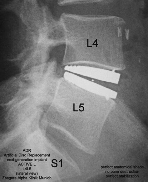 Pin on Artificial total disc replacement this is the surgery I need