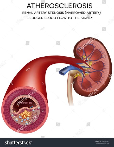 Renal Artery Disease. Atherosclerosis, Fatty Plaque Developing On The Inside Of The Artery To ...