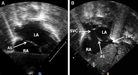 Echo frames from subcostal long-axis (A) and short-axis (B) views... | Download Scientific Diagram