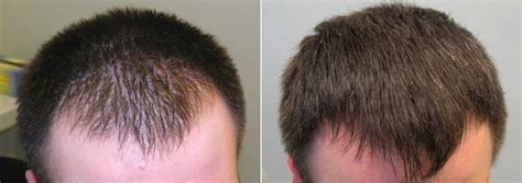 Finasteride Before and After Photos [2024]