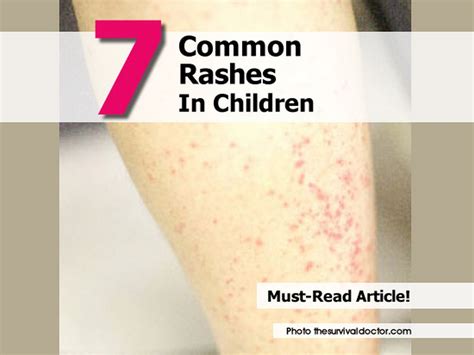 7 Common Rashes In Children