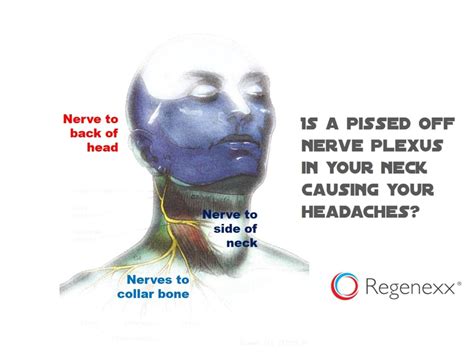 Pain in Side of the Neck and Head? Meet the Superficial Cervical Plexus - Regenexx