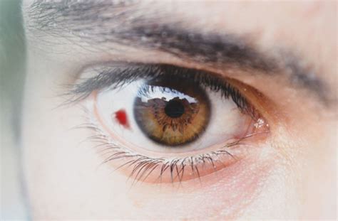 Blood in eye (subconjunctival hemorrhage): Causes and treatment