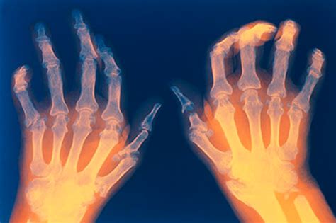 Got arthritis? Your job might be the problem... - ASAIPA