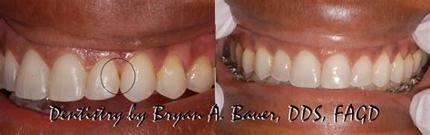 Closing black triangles teeth after braces - Bauer Smiles