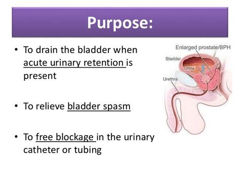 Cystoclysis bladder irrigation