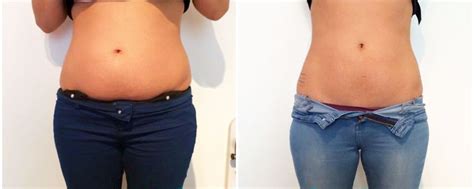 Cavitation v Fat Freezing (Cryolipolysis) | A New You