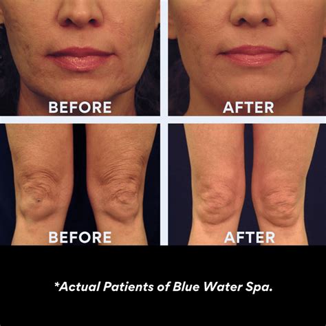 Laser Skin Tightening for the Face and Body | Blue Water Spa