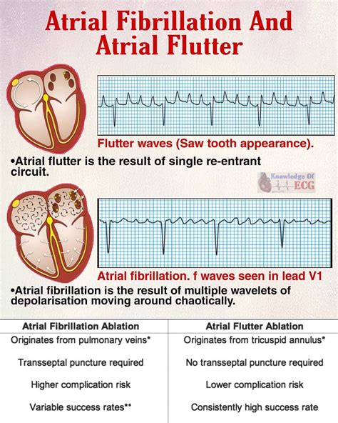 Atrial Fibrillation Vs Atrial Flutter Ecg