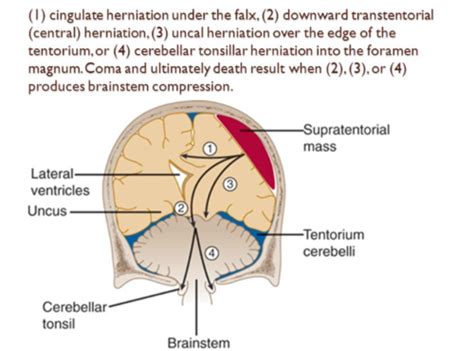 Tentorial Notch And Foramen Magnum