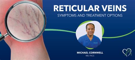 Reticular Veins: Symptoms and Treatment Options