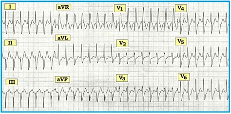 ECG Interpretation: ECG Interpretation Review #38 (WCT - SVT - VT - Fascicular - RBBB Aberration ...