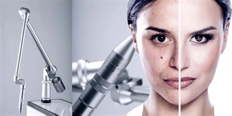 What Is Q Switch Laser Treatment