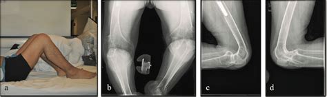 | Patient with a severe bony knee flexion contracture before surgery ...