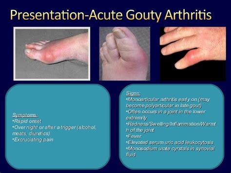 Signs and symptoms of chronic tophaceous gout - how to alleviate uric acid pain best homeopathic ...