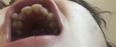 quad helix day 1. : r/braces