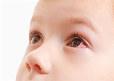 Types of Eye Infections in Children and How to Prevent Them - Pediatric ...