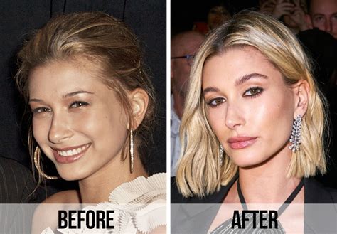 Hailey Bieber Nose Job An In-Depth Look - Cosmeticium