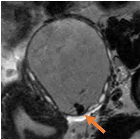 MRI of Endometriosis - RAD-ASSIST