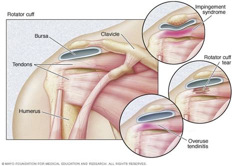 Rotator cuff injury - Symptoms and causes - Mayo Clinic