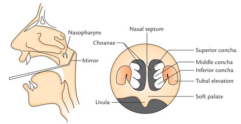 nose - POSTERIOR RHINOSCOPY Treatment - Dr. Meenesh Juvekar - ENT ...