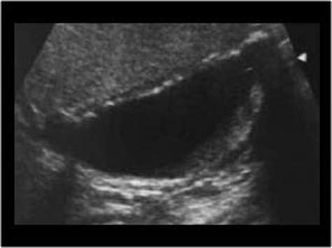 Abdomen and retroperitoneum | 1.2 Gallbladder and bile ducts : Case 1.2.13 Gallbladder ...