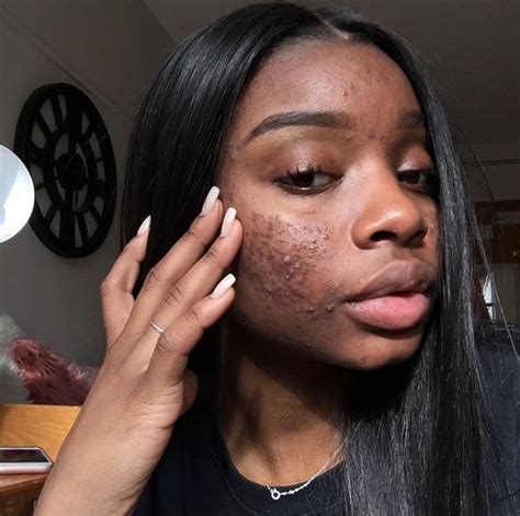 christin-eee | Girl with acne, Bare beauty, Skin