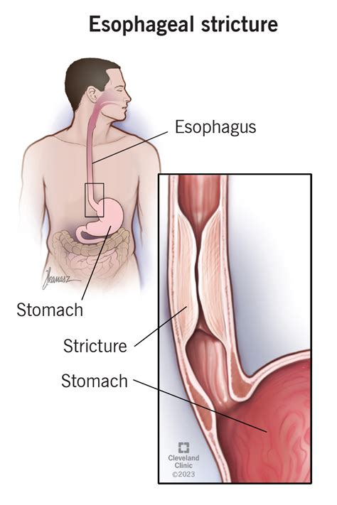 Esophageal Strictures: Symptoms, Causes & Treatment