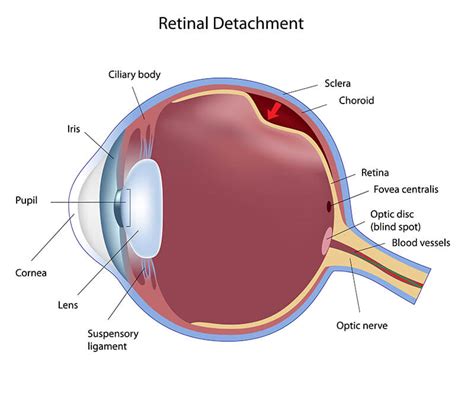 Retina Boston | Retinal Detachment Boston | NEEC