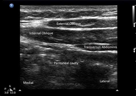 USRA - Transversus Abdominis Plane (TAP) Block