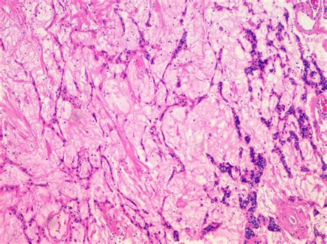 Pathology Outlines - Eccrine spiradenoma