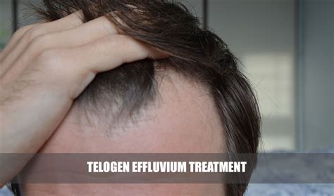 Telogen Effluvium: Causes, Regrowth and Treatment in Thane