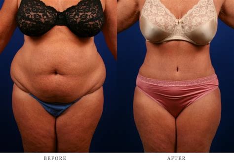 Bailey Cosmetic Surgery & Vein Centre: What Is the Difference Between a Tummy Tuck and a Mini Tuck?