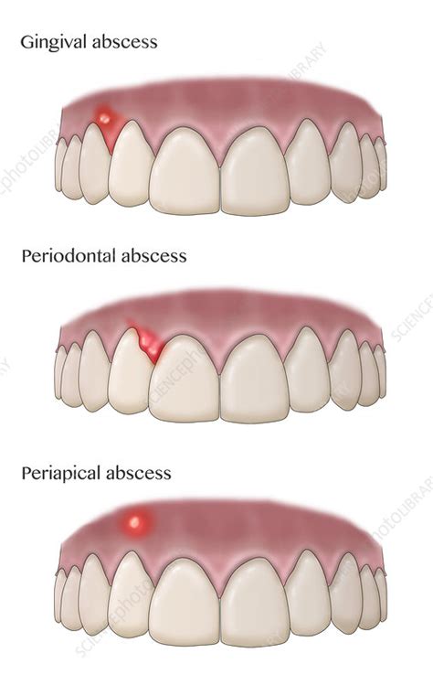 Types of Dental Abscesses, Illustration - Stock Image - C036/6292 ...