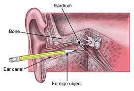 Tympanic Membrane Rupture Complications & Causes | Dr. Thind