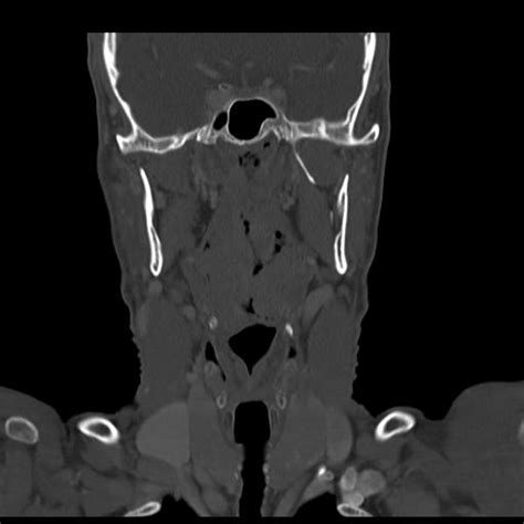 Oropharyngeal squamous cell carcinoma | Image | Radiopaedia.org